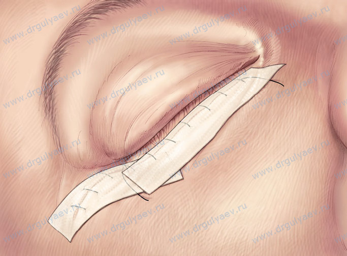 Операция заканчивается дополнительной фиксацией шва специальными наклейками