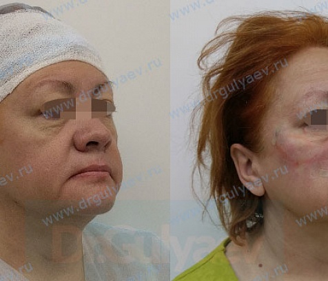 Армирование средней и нижней третей лица: Aptos Excellence Visage