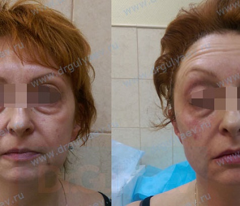 Армирование средней и нижней третей лица: Aptos Excellence Visage