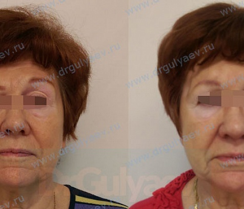 Коррекция асимметрии бровей у пациентки с повреждением левой височной ветви лицевого нерва - нити Aptos